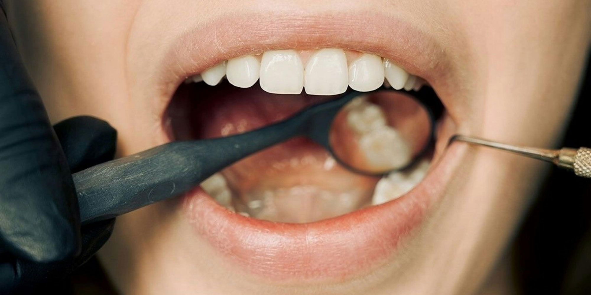 A close up of a mouth having a dental check up